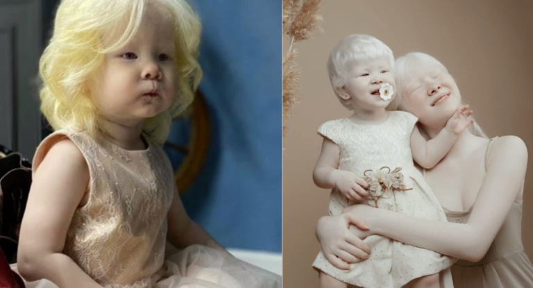 Albino Sisters Born 12 Years Apart Amaze Whole World With Their Extraordinary Beauty